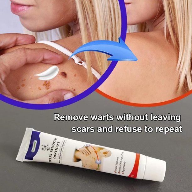 2pcs Xpreen Skin Tag Remover, Warts and Mole Remover Cream, Advanced Skin Tag Removal Treatment Formula, Natural Ingredients, Safe and Painless, Easy to Apply